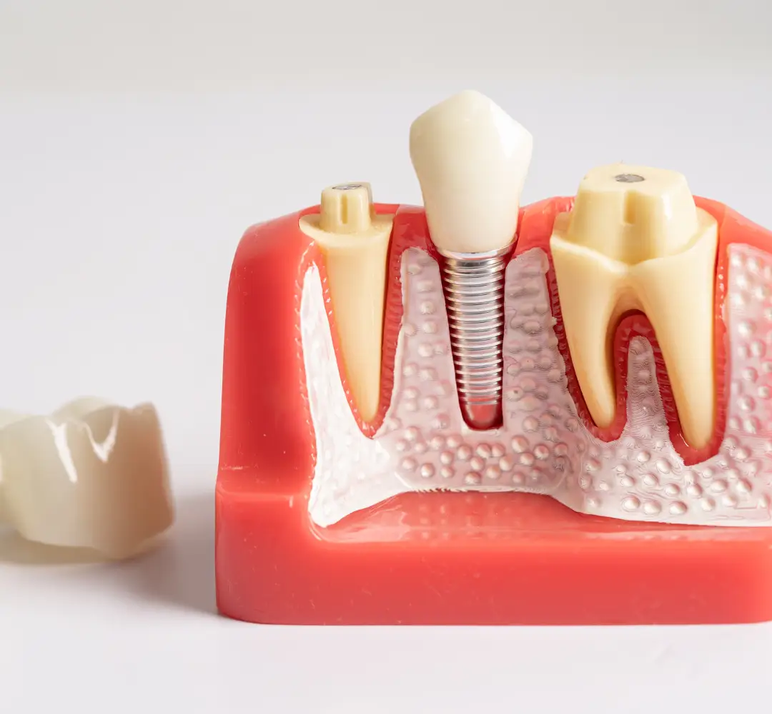 Dental Crown and Implant options