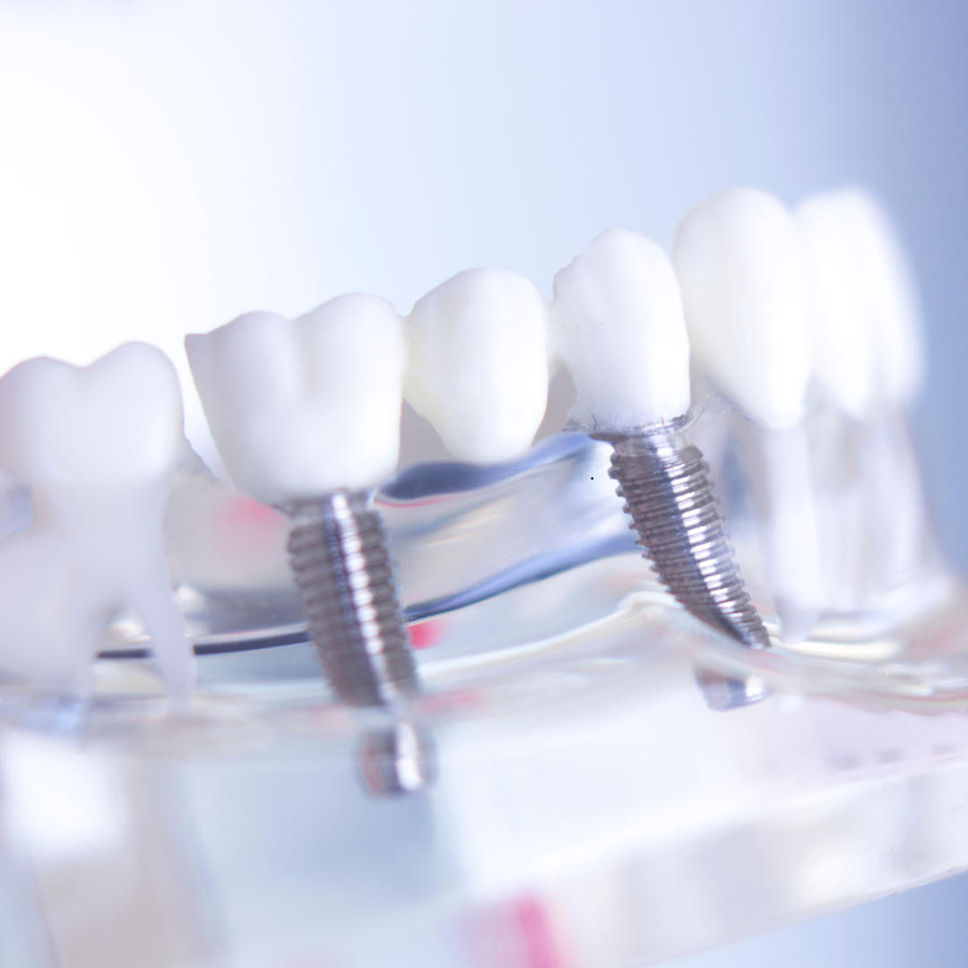 Dental Implants
